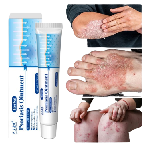 Kem bôi vảy nến á sừng mụn nước Herbal