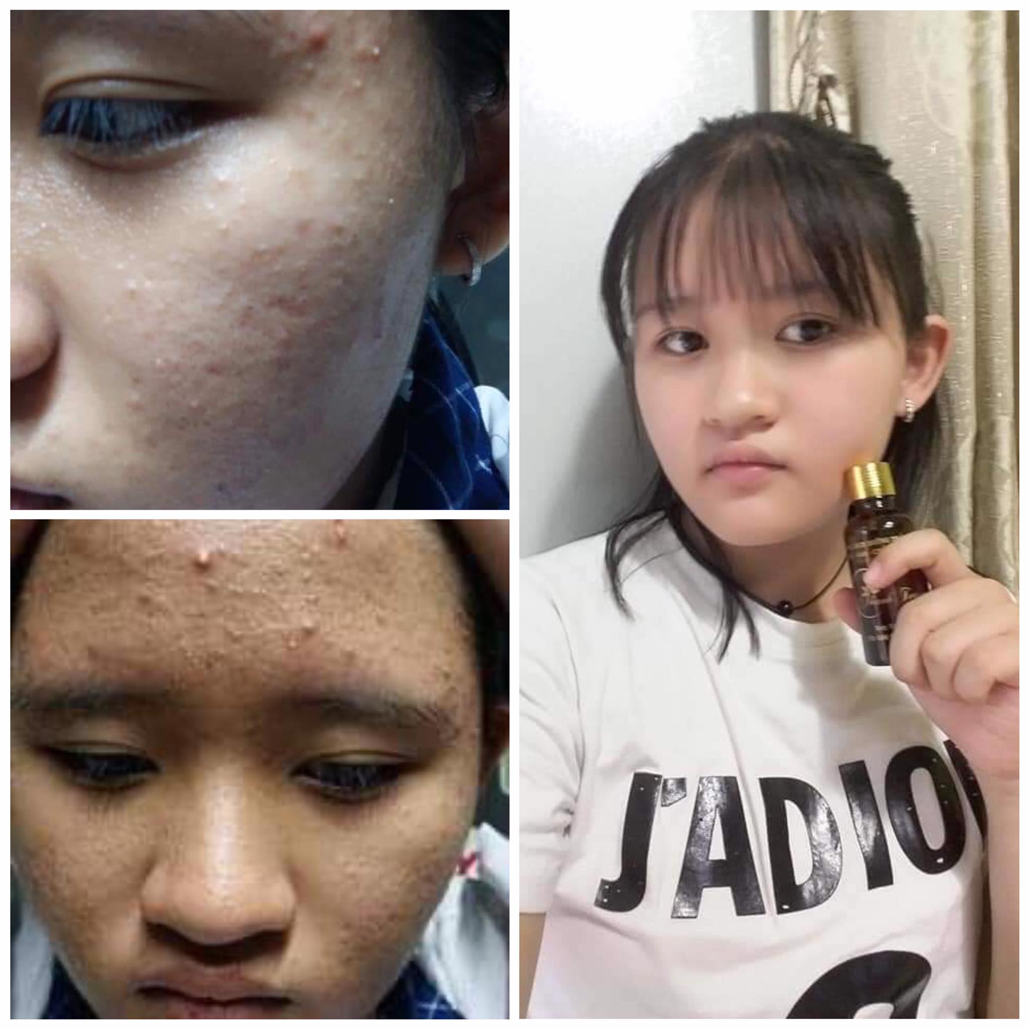 Linh chi vi mụn