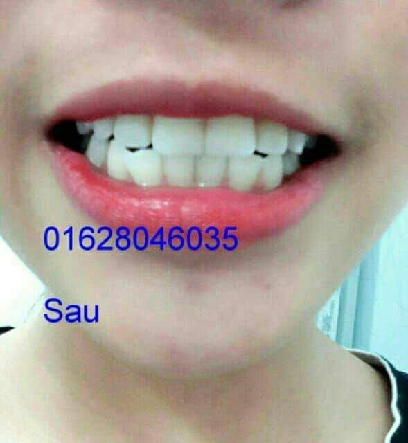 Máng Tẩy Trắng Răng Tại Nhà Khít Răng 100%