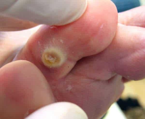 chai chân, mụn cóc, chai sừng, mụn cơm, virut hpv, smg