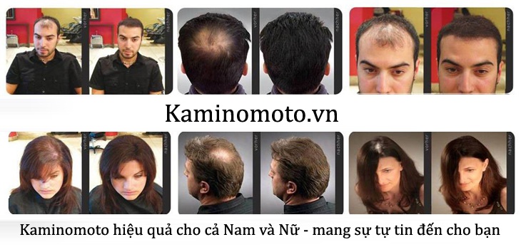 Sản phẩm mọc tóc Nhật Bản - Kaminomoto Higher Strength