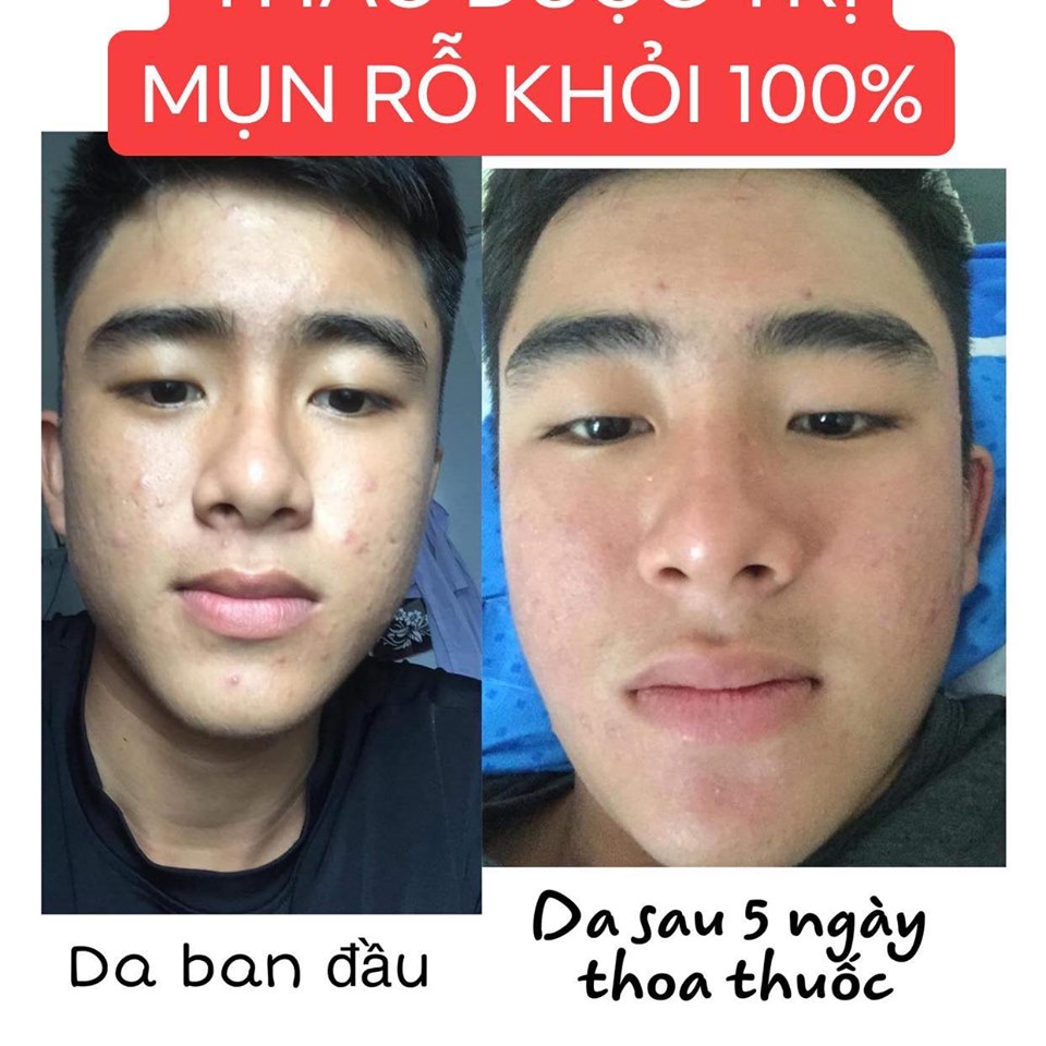 Thảo dược sạch mụn thâm rỗ không tái lại (50ML)