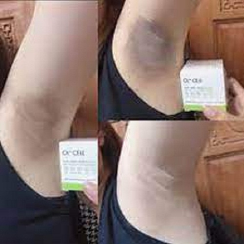 [HCM][ CHÍNH HÃNG ] Kem Trị Thâm Nách Thâm Môi Thâm Đầu Gối OL-CELL