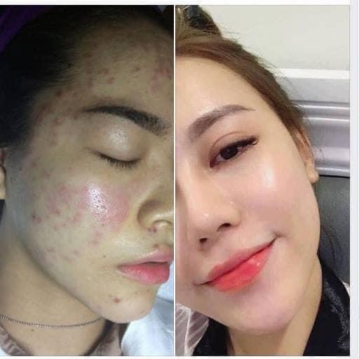 Cao lá nam diếp cá đen đặc GÔM NHÂN MỤN SAU 1 NGÀY SỬ DỤNG SẠCH MỤN THÂM NÁM DƯỠNG TÁI TẠO TRẮNG SÁNG NHANH CHÓNG