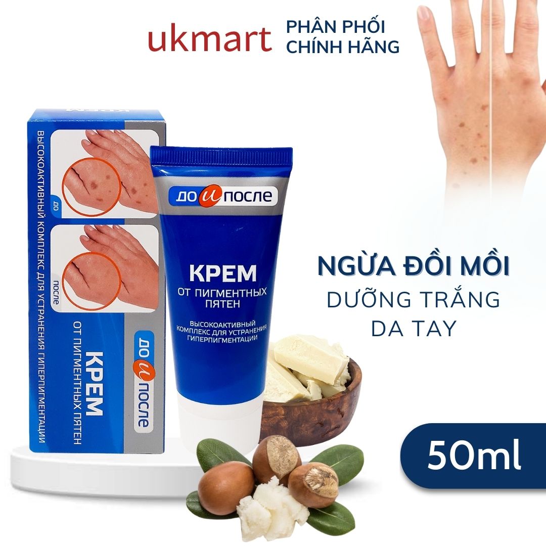 Kem làm giảm đồi mồi vết nám sạm đốm nâu tay chân kpem nga