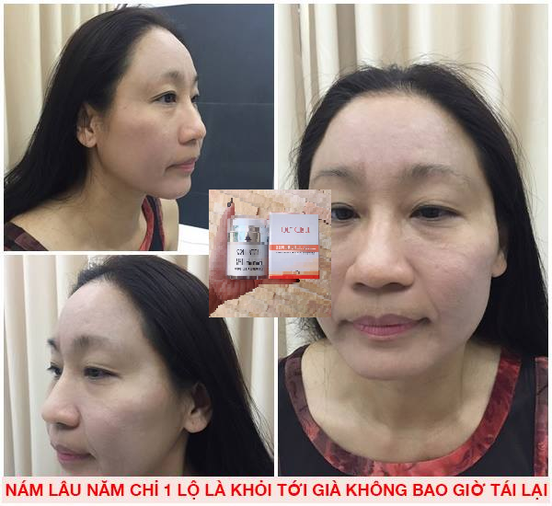 ( Mua 1 tặng 1) Olcell hút nám tặng kem trắng da mặt 22Again