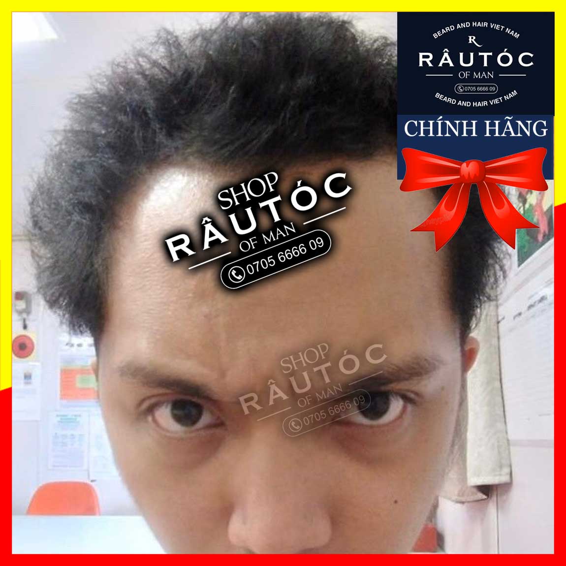 LCLT giúp tăng hiệu quả mọc tóc nhanh