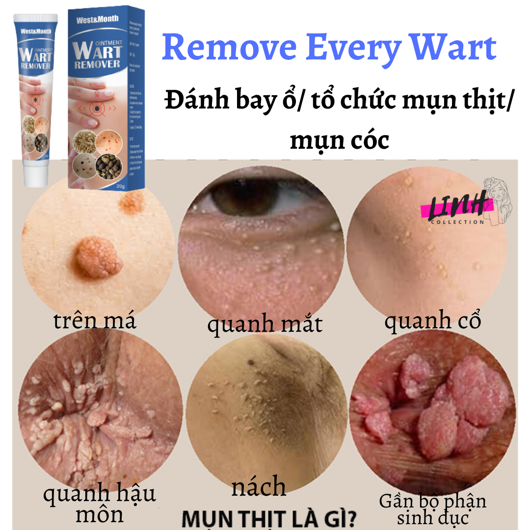 {ĐÁNH BẬT} MỤN CÓC, MỤN THỊT,MỤN CƠM,MỤN RUỒI TRÂU REMOVE EVERY WARTS CHÍNH HÃNG