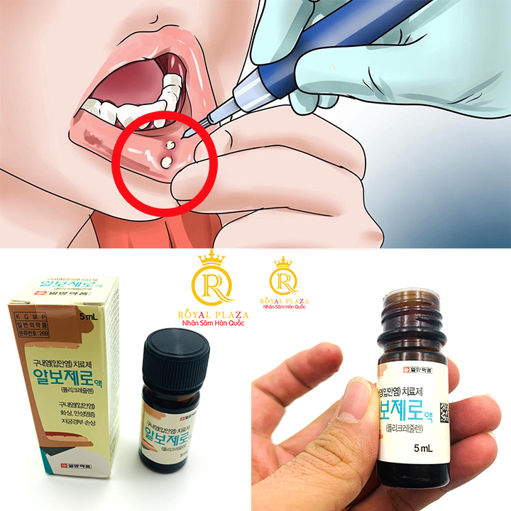 Lọ chấm Nhiệt Miệng Hàn Quốc nhậy và an toàn dùng cho cả gia đình, chấm 2-3 lần là đỡ ngay