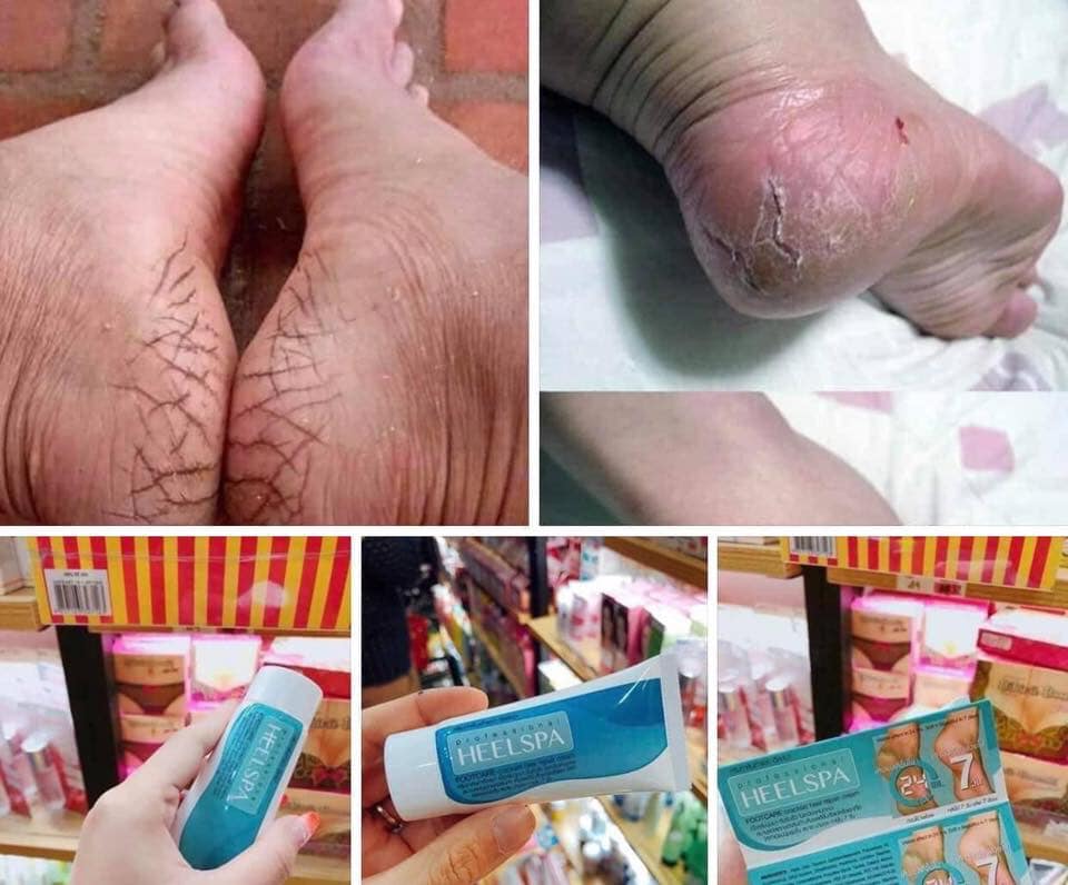 Kem thoa nứt gót chân Heel Spa - Thái lan