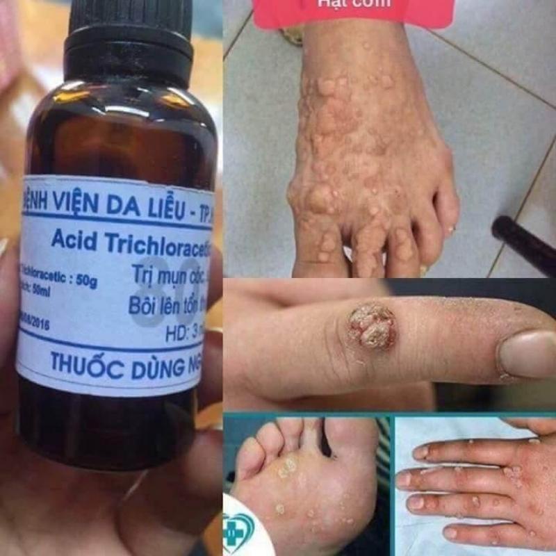 Lọ chấm mụn cơm, mụn cóc, mụn thịt, chai chân Acid Trichloracetic 80%