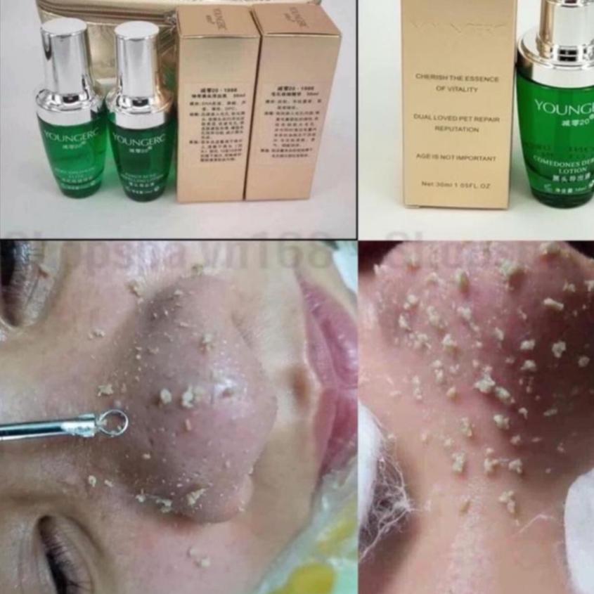 Ủ Mụn Youngerc, Ủ Mụn Cám Lột Sạch Mụn Trên Da Mặt Mũi.