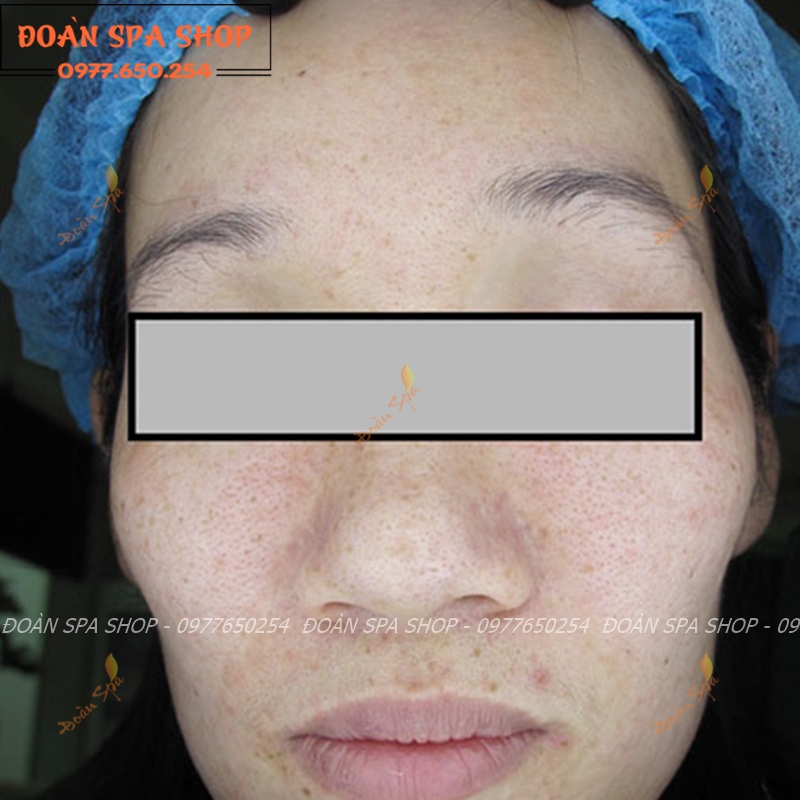 Đèn wood soi da dùng trong spa thẫm mỹ viện