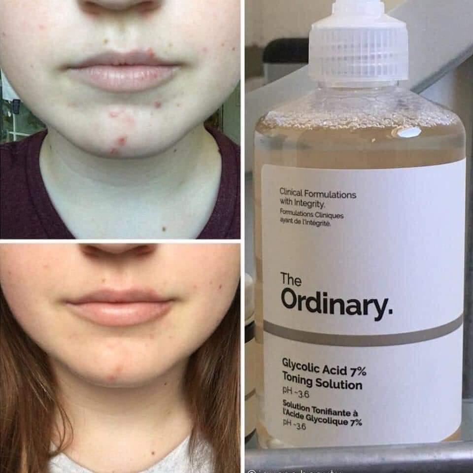NƯỚC HOA HỒNG The Ordinary. Glucolic Acid 7% Toning Solution 240ML