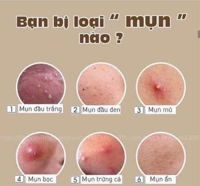 Kem  mụn SPA ACNE