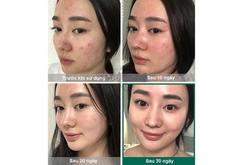Kem Dưỡng Cho Da Mụn Some By Mi AHA-BHA-PHA 30 Days Miracle Cream
