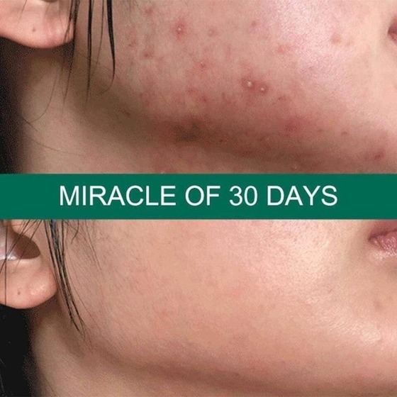 Kem Dưỡng Some By Mi AHA-BHA-PHA 30 Days Miracle Cream