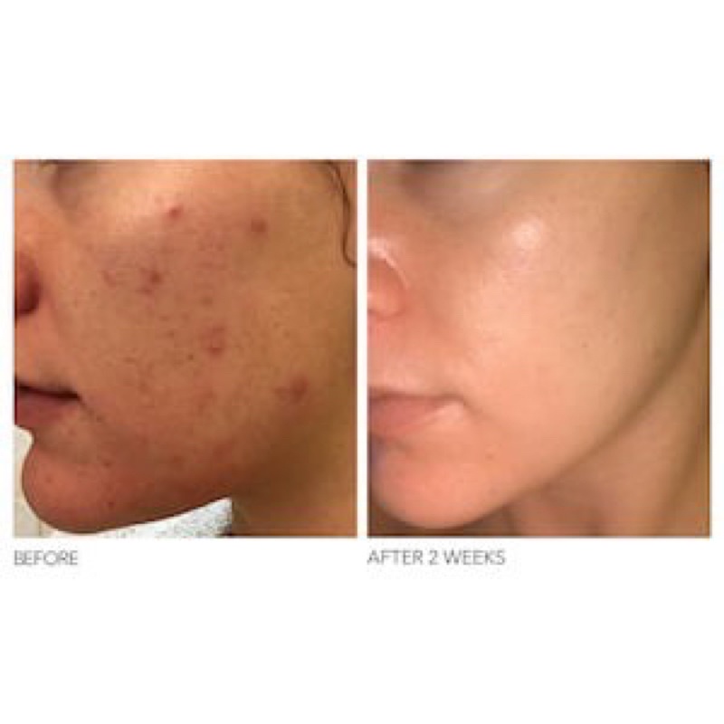 Peel da Dr Dennis Gross Alpha Beta Extra Strength Daily Peel (2 gói - 2 bước)