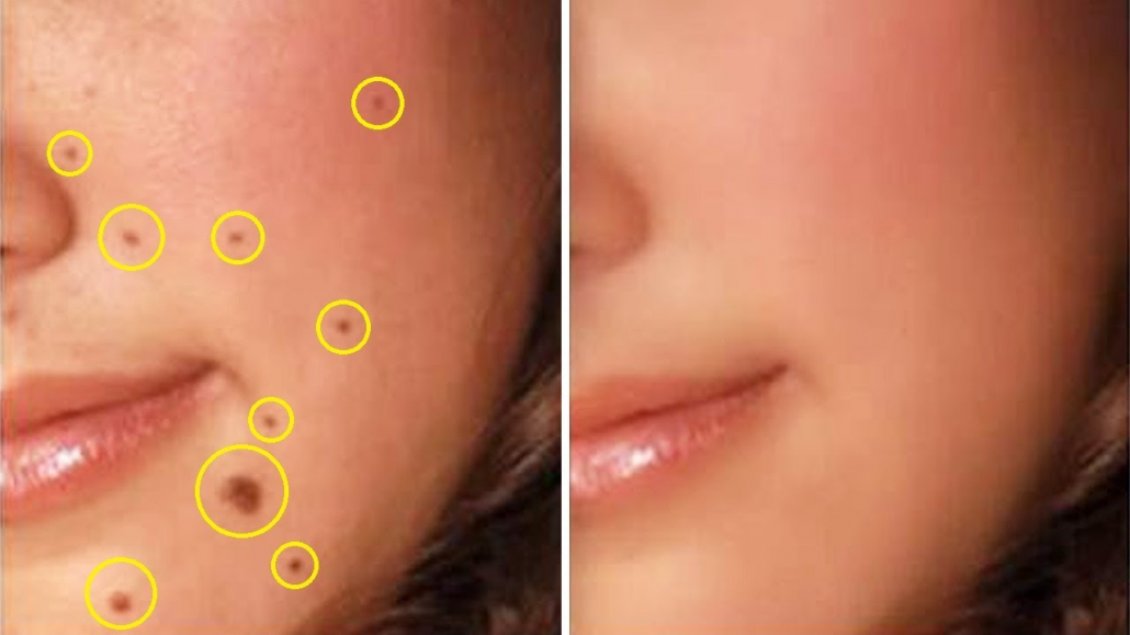 Máy Đốt Nốt Ruồi Mụn Thịt 3 Tốc Độ