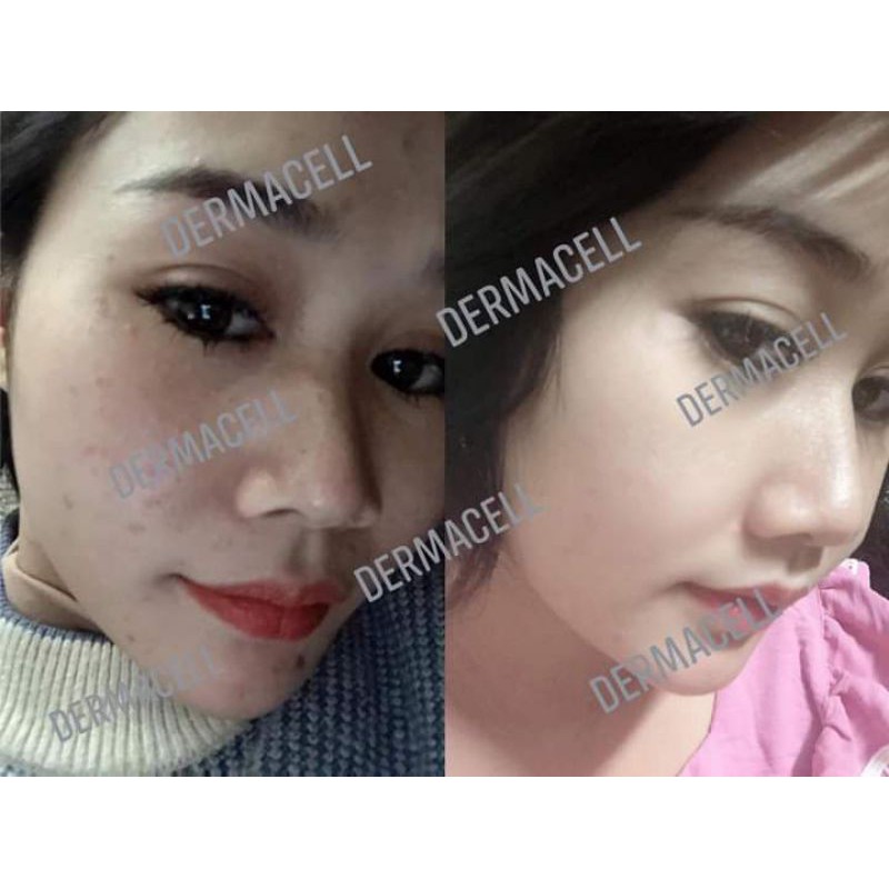 Serum Remex7 Tế bào gốc thực vật