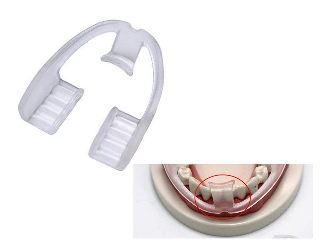 [HCM]DỤNG CỤ CHỐNG NGHIẾN RĂNG - BẢO VỆ RĂNG MIỆNG