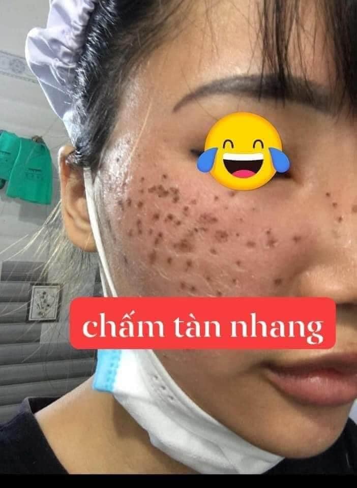 Chấm tàn nhang Yody White Phương Anh