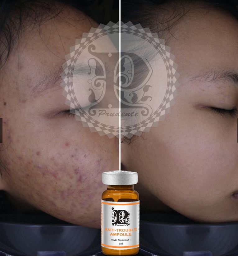 Serum Mụn Anti Trouble Ampoule [ MIBITI ] 5ml/Chai