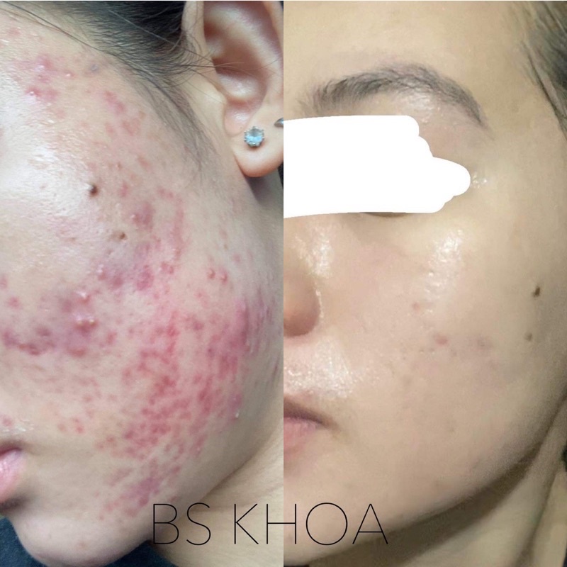Chấm mụn viêm sưng Biotrade Acnaut Active Lotion
