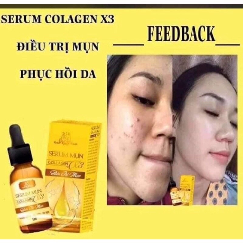 Serum Mụn Collagen X3 - Siêu Ngừa Mụn 5ML