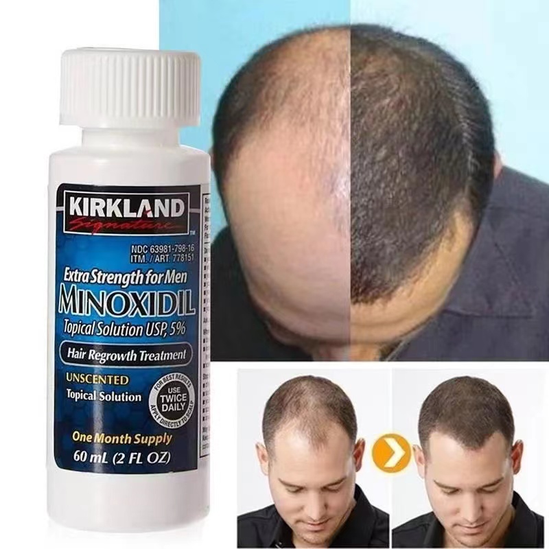 Minoxidil Kirkland 5% Minoxidil với giọt miễn phí (60ml mỗi chai)