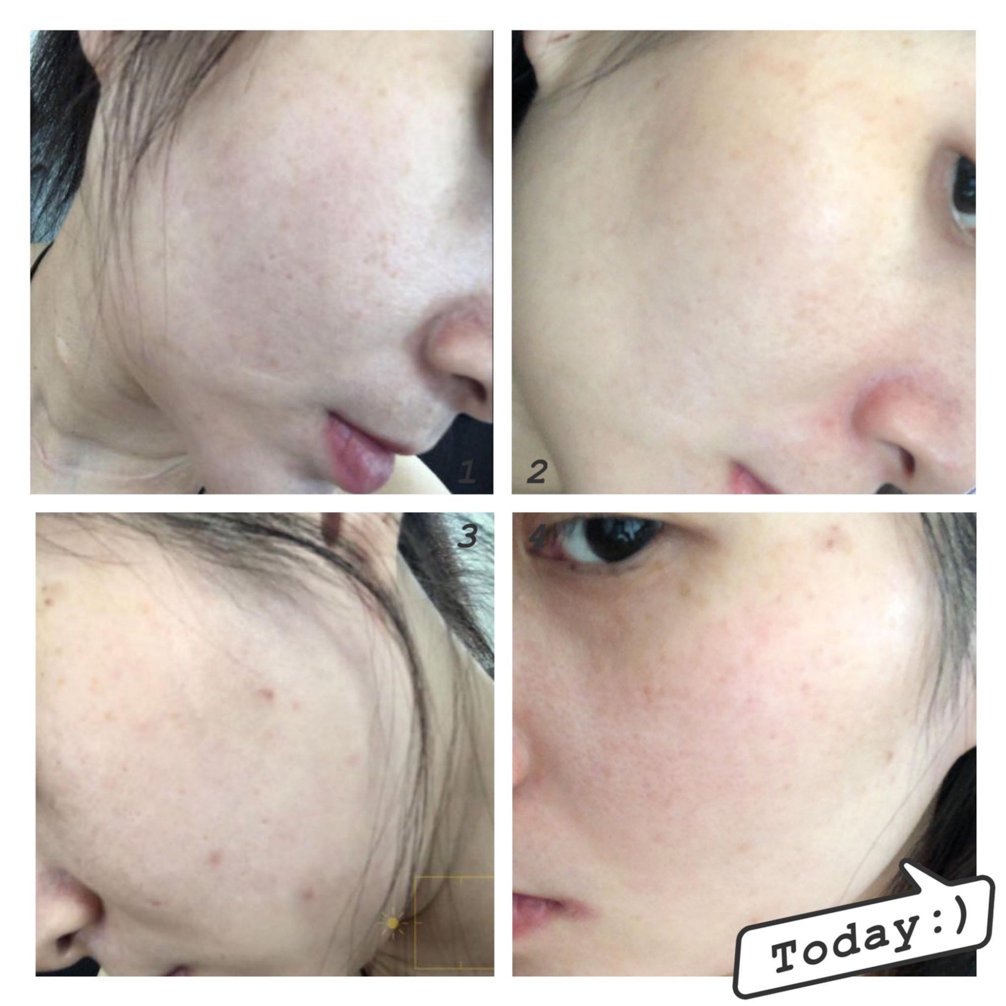 Bộ Phục Hồi Da Yếu Nhạy Cảm Oshirma