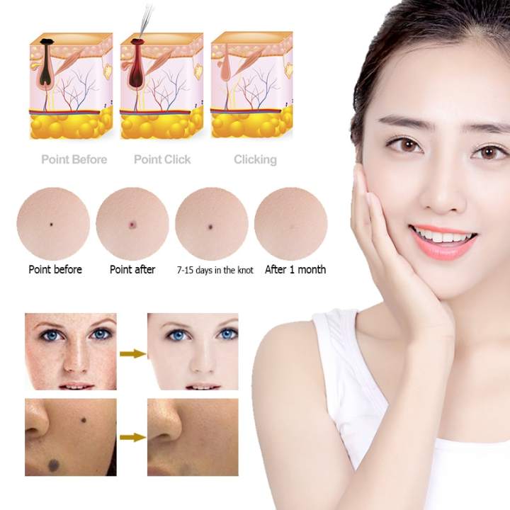 Máy Đốt Nốt Ruồi Laser Mụn Đốt mụn thịt dùng trong spa