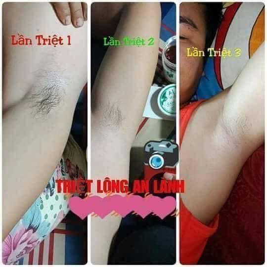Combo triệt lông An Lành