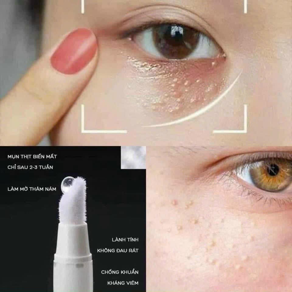 KEM XÓA MỤN THỊT TSUBUPORON NHẬT BẢN 1.8ml