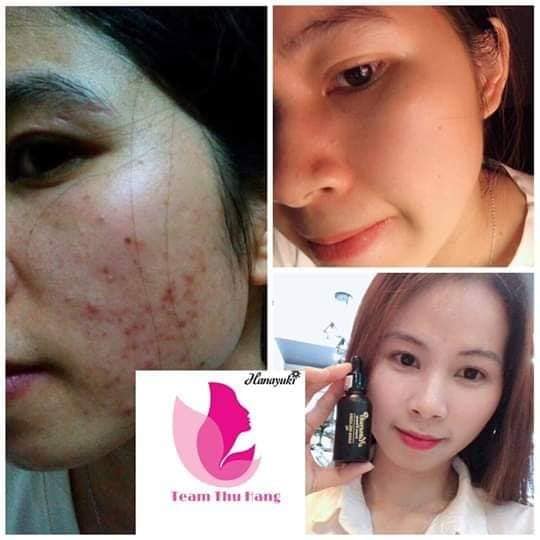 Serum Trị Mụn Hanayuki - Hana Acnes