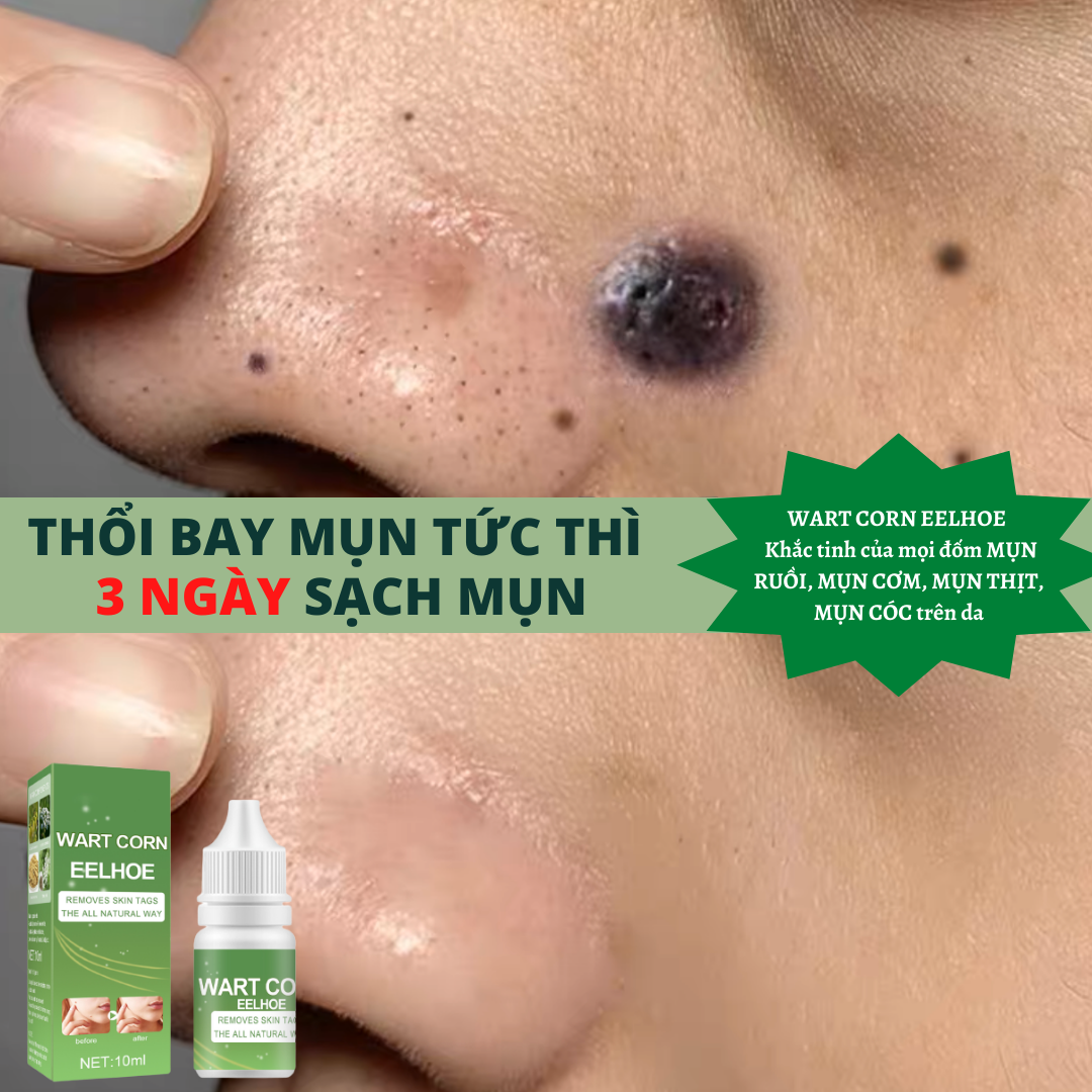 Dung dịch loại bỏ dứt điểm và vĩnh viễn – Tận gốc MỤN RUỒI, MỤN CÓC, MỤN THỊT, MỤN CƠM, NÁM TÀN NHANG bay nhanh trong vòng một nốt nhạc
