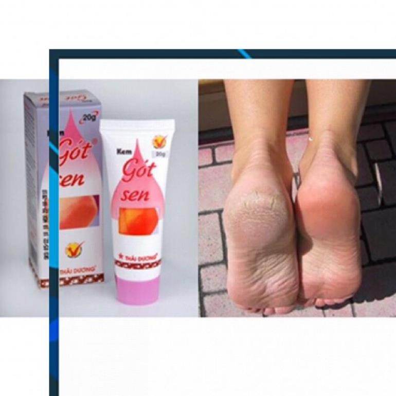 [Tuýp 20g] Kem Gót Sen  - Ngừa nứt nẻ Gót chân