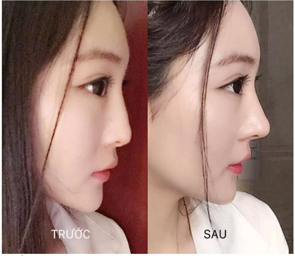 [HCM]Bộ dụng cụ nâng mũi 3D Hàn Quốc #NM6