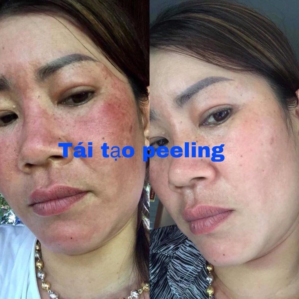 Mẫu mới - Kem Peeling Tái Tạo Da Mặt.