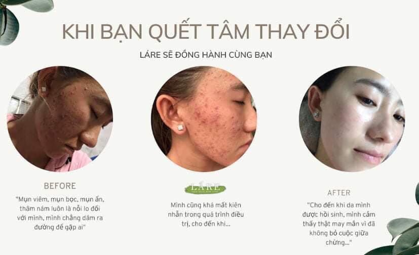 Serum thảo mộc thanh dược Lare 80ml