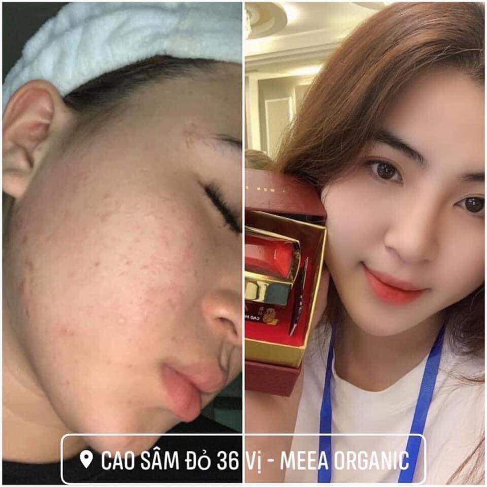 [HCM]CAO MỤN SÂM ĐỎ ( HỦ LỚN 15G)