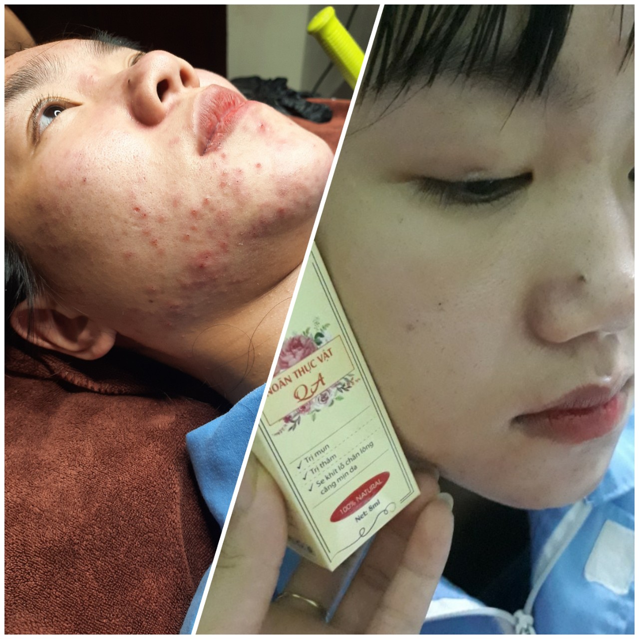 Noãn thực vật QA Beauty