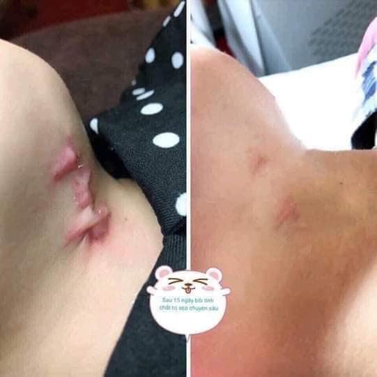 Kem Mờ Sẹo Gentacin Nhật 10g