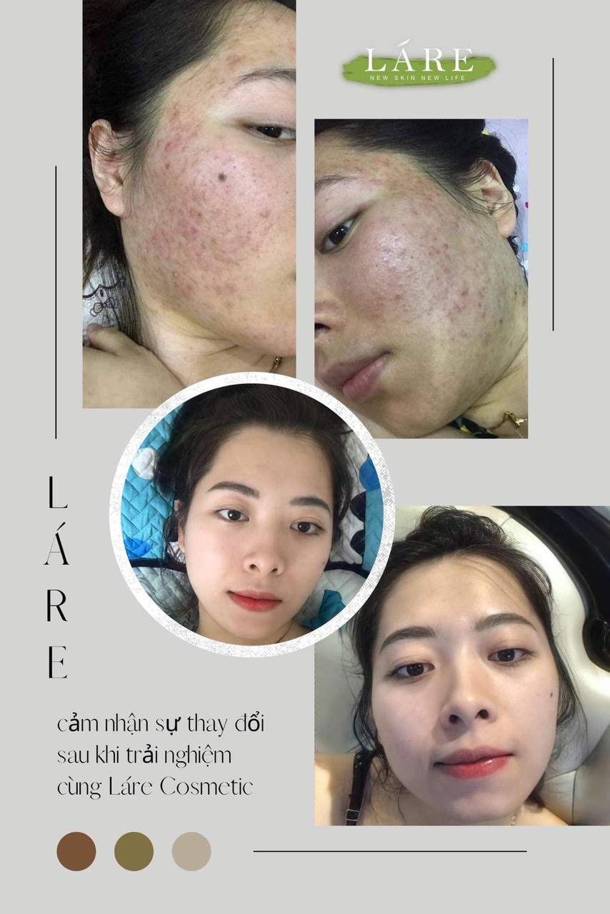 Serum Thanh Dược Lare chiết lẻ 10ml