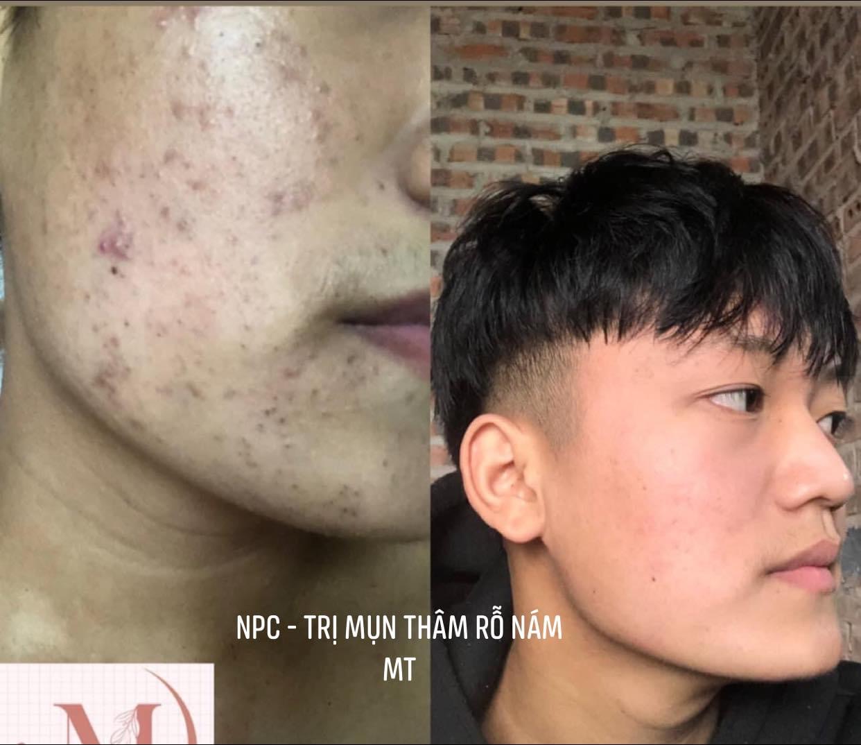 Thảo dược sạch mụn thâm rỗ không tái lại (50ML)