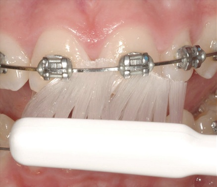 Bàn chải đánh răng TEPE (Implant / Chỉnh nha) - Lông bàn chải siêu mềm
