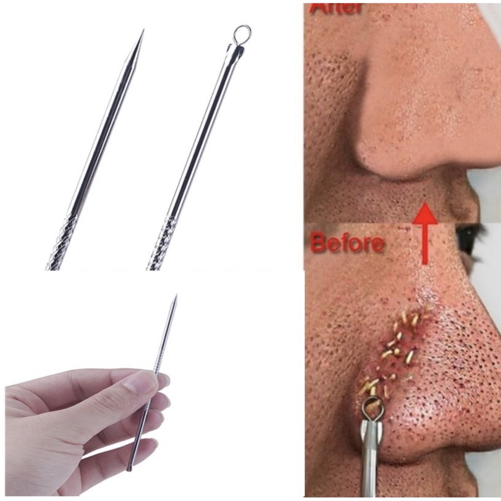 [HCM]Que nặn mụn thép không gỉ