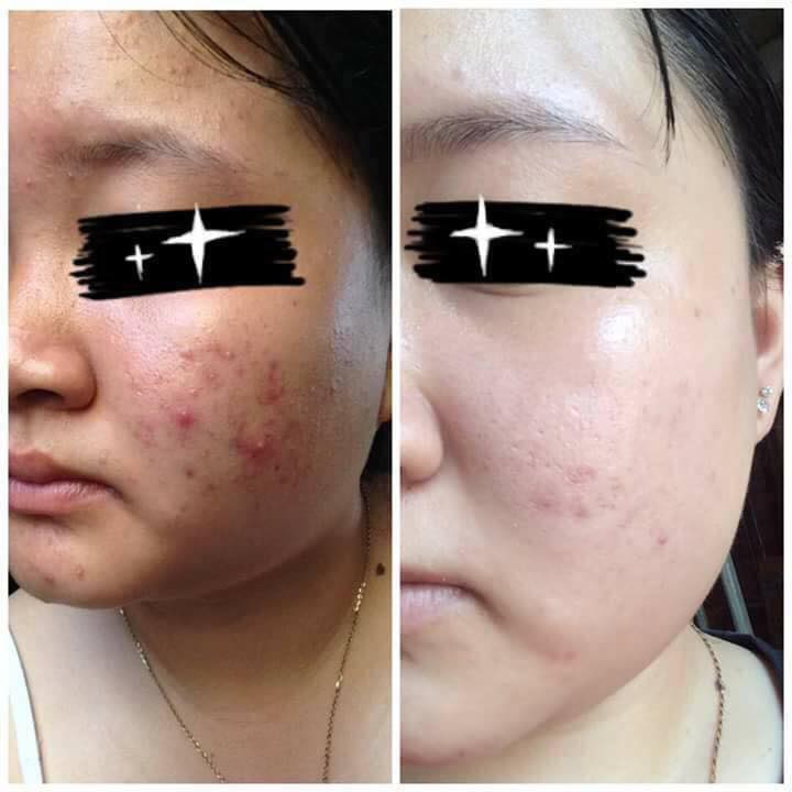 Kem mụn ngừa thâm Fairy 15gr