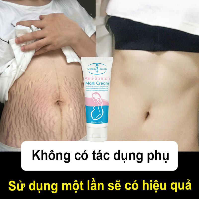 Kem trị rạn da Kem xóa sẹo 60ML, vết rạn sau sinh, vết thương phẫu thuật