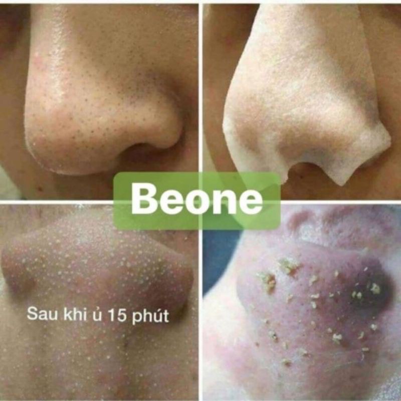 Tinh chất ủ mụn đầu đen, ủ mụn cám Youngerc